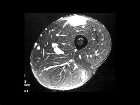 Rectus Femoris Musculotendinous Junction Tear Result Of Surgical