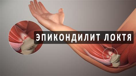Что такое эпикондилит локтевого сустава? - YouTube