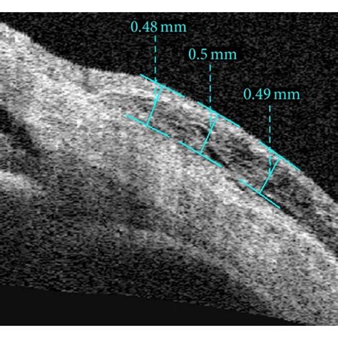 Imaging Of As Oct Shows Measurement Of Thickness Of The Conjunctival Download Scientific