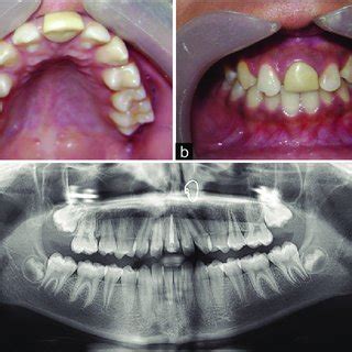 A Intraoral Photograph Showing Reduction Of Spaces Between Maxillary