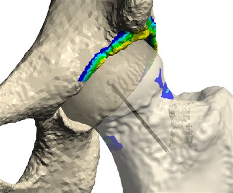 FAI | Vancouver Hip Institute | Hip Preservation Vancouver, BC