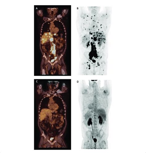 Positron Emission Tomography With A C And Without Computed