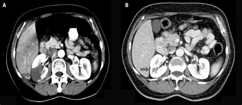 A B Contrast Enhanced Abdominal Computed Tomography Images At The