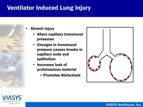 PPT Ventilator Induced Lung Injury PowerPoint Presentation Free