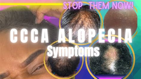 What Are The Symptoms Of Central Centrifugal Cicatricial Alopecia CCCA