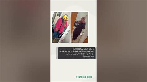 بعد عملية تحويل مسار المعده تحويل مسار قبل وبعد تجارب تحويل مسار