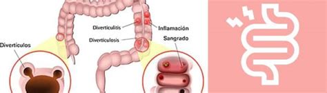 Diverticulitis Que Es Causas Síntomas Y Tratamientos