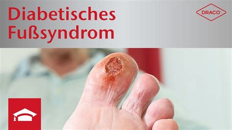 Diabetisches Fu Syndrom Diagnostik Fr Herkennung Polyneuropathie