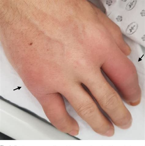 Figure 2 From Pancreatitis Panniculitis And Polyarthritis Syndrome Simulating Cellulitis And