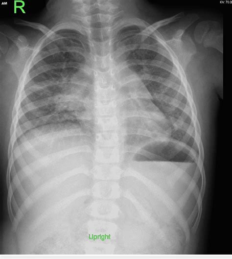 Chest X Ray On Admission Showed Right Lung Midzone And Left Download Scientific Diagram