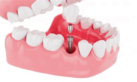 What To Know Before Getting Dental Implants Nuface Dental Implant Center