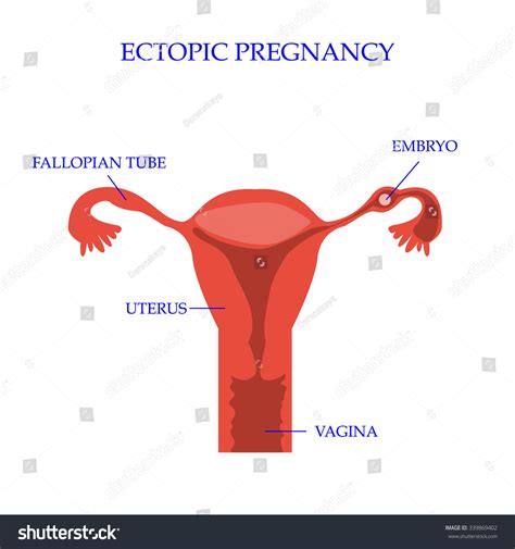 Ectopic Pregnancy Concept Vector Illustration Shutterstock