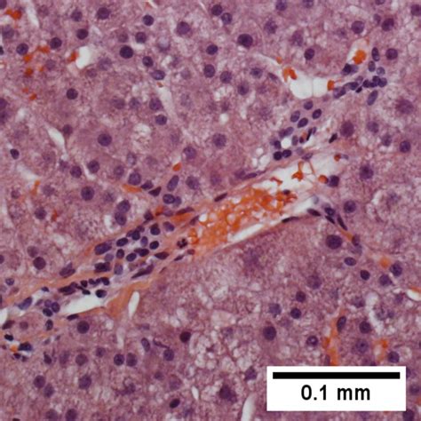 Congestive Hepatopathy Libre Pathology