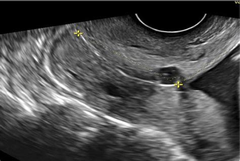 Management Of Cervical Heterotopic Pregnancy With Inevitable