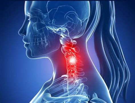 Spondylose cervicale symptômes et traitements Améliore ta Santé