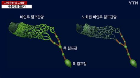 국내에서 세계최초로 치매 유발 뇌 노폐물 배출 경로 찾았다 유머이슈 꾸르