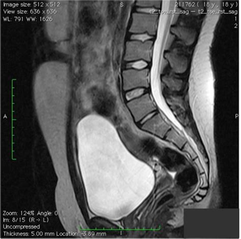 Magnetic Resonance Imaging Scan Showing The Absence Of The Urachal Cyst