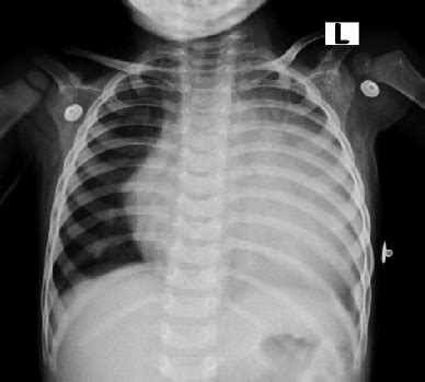 Chest x-ray showing massive cardiomegaly. | Download Scientific Diagram