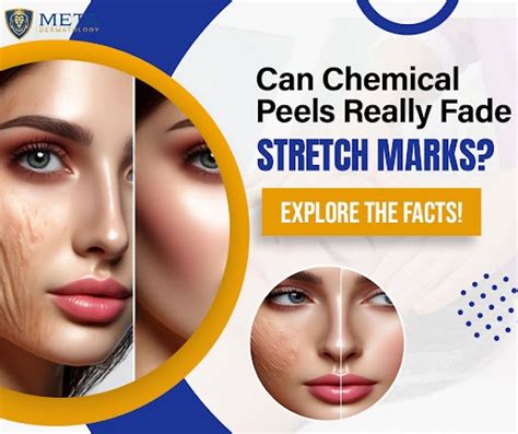 Are Chemical Peels A Good Option For Treating Stretch Marks