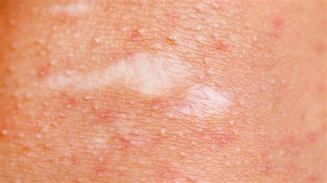 How To Prevent And Treat Common Skin Conditions Everyday Health