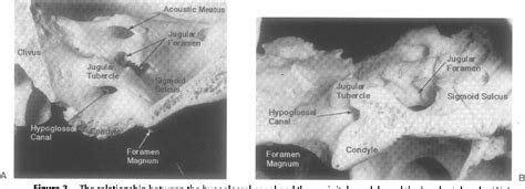 Figure From Microsurgical Anatomy For Lateral Approaches To The