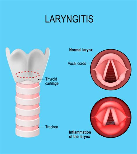 Laryngitis In Kids: Types, Causes, Symptoms, And Treatment