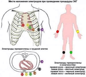 Наложение электродов при ЭКГ: как их накладывать, схема наложения и ...
