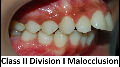 Class Ii Malocclusion Treatment Malcom Hitt