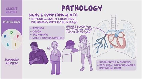 Venous Thromboembolism (VTE) – McMaster Pathophysiology, 59% OFF