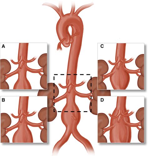 Open And Endovascular Management Of Aortic Aneurysms Circulation Research