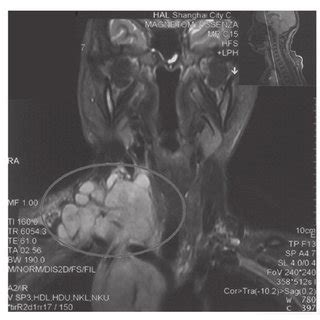 Enhanced Magnetic Resonance Imaging Scan Showing A Unilateral Lesion In