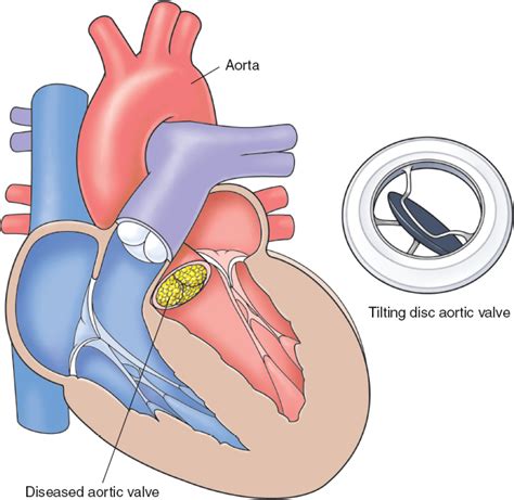 Conduction Blocks Thoracic Key