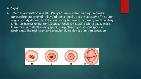 Cervical Ectopy or cervical erosion.pptx