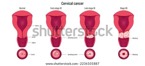 Cervical Cancer Development Cervix Carcinoma Stages Stock Vector ...