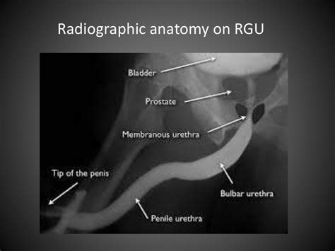 Anterograde Retrograde Urethrography Rgu Mcu