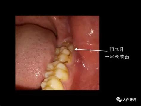 智齿不痛就不用拔吗？看了这篇你就懂了！ 知乎