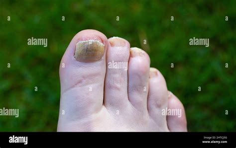 Toenail Fungus showing on the big toe Stock Photo - Alamy