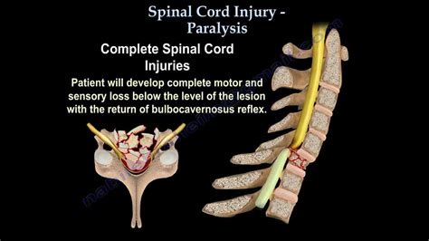 Spinal Cord Injury Paralysis Everything You Need To Know Dr Nabil Ebraheim Youtube