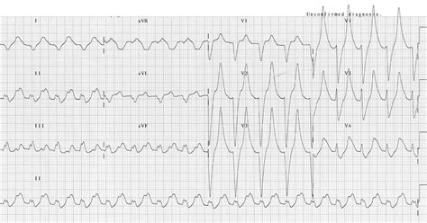 Hypokalemia Hyperkalemia Ecg