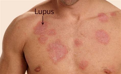 Lupus Symptoms: 13 Ways to Spot Lupus Disease Early