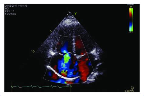 Pre Operative Color Doppler Echocardiography Revealing Severe Tricuspid