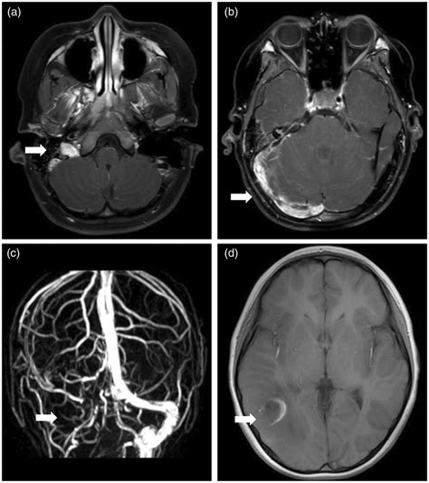 Magnetic Resonance Imaging Mri Of Vascular Plaque In Our Patients