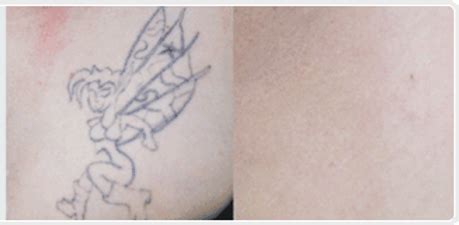 Tattoo Removal Cream Proven to Work