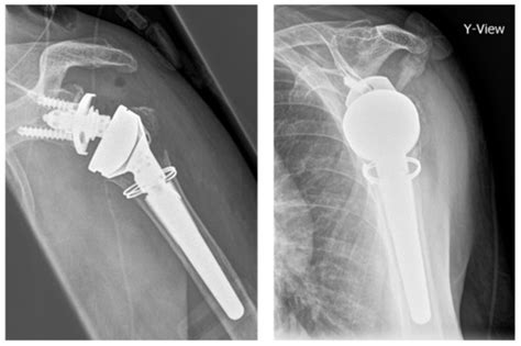 biomechanical    protective proximal humeral cerclage