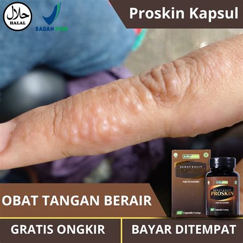 Jual Obat Tangan Berair Pengering Kulit Berair Dan Gatal Bernanah