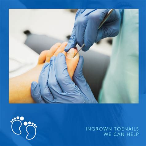 Ingrown Toenail Procedures