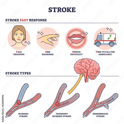 Stroke Medical Condition With Fast Response And Types Outline Diagram