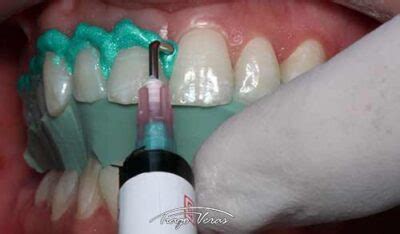 Clareamento Dental Dentista Em Londrina Dr Tiago Veras