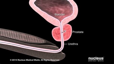 What Is Benign Prostatic Hyperplasia Bph Youtube