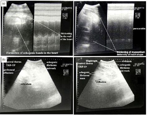 Diagnostic Significance Of Ultrasonography In Complicated Traumatic